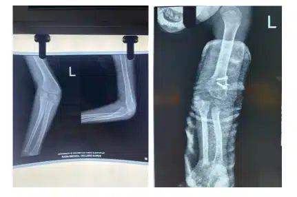 Before and after image of limb deformity correction done on a child by the orthopedics Team at Rama Hospital Hapur. 