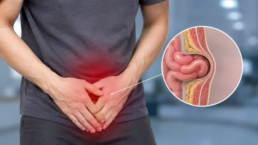 What Causes a Hernia
