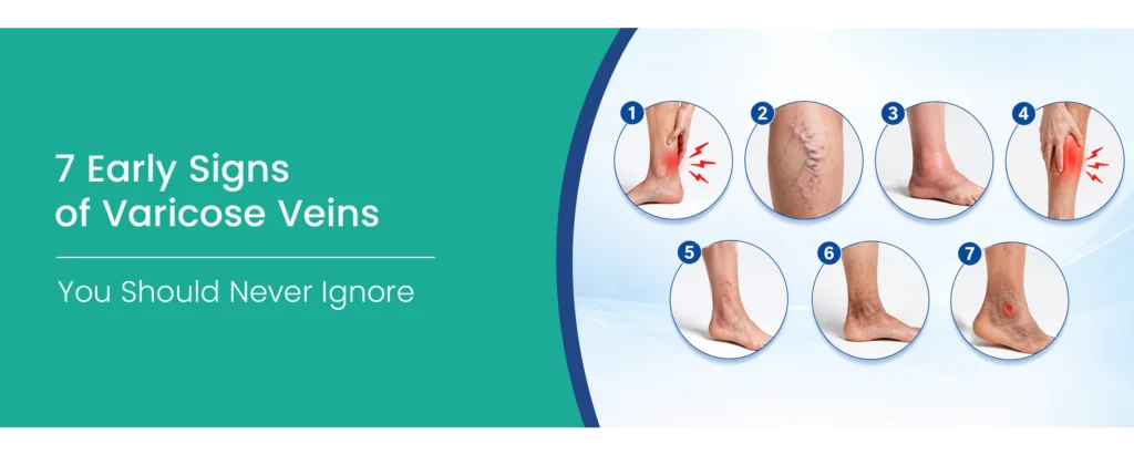Early signs of Varicose veins
