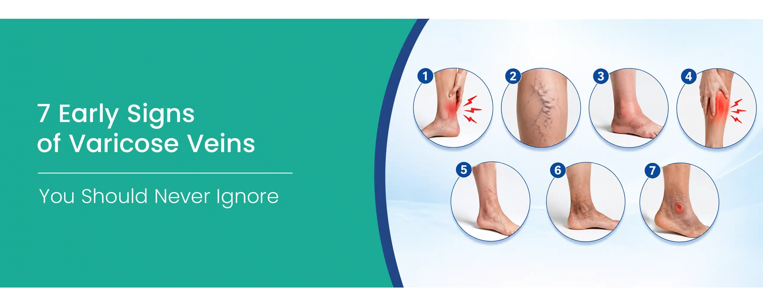 Early signs of Varicose veins