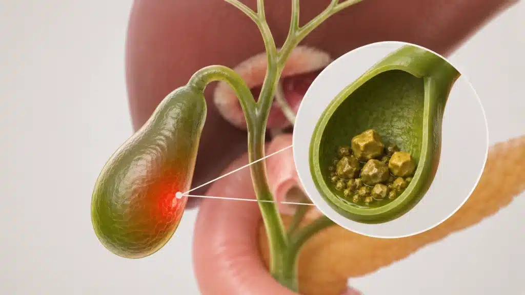 Gallbladder Stones