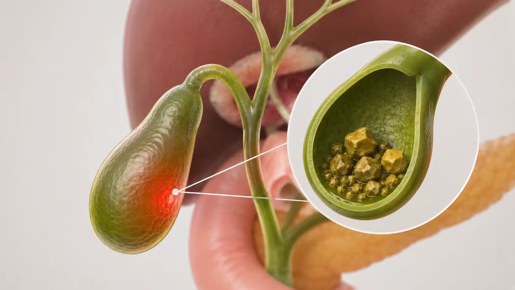 Gallbladder Stones