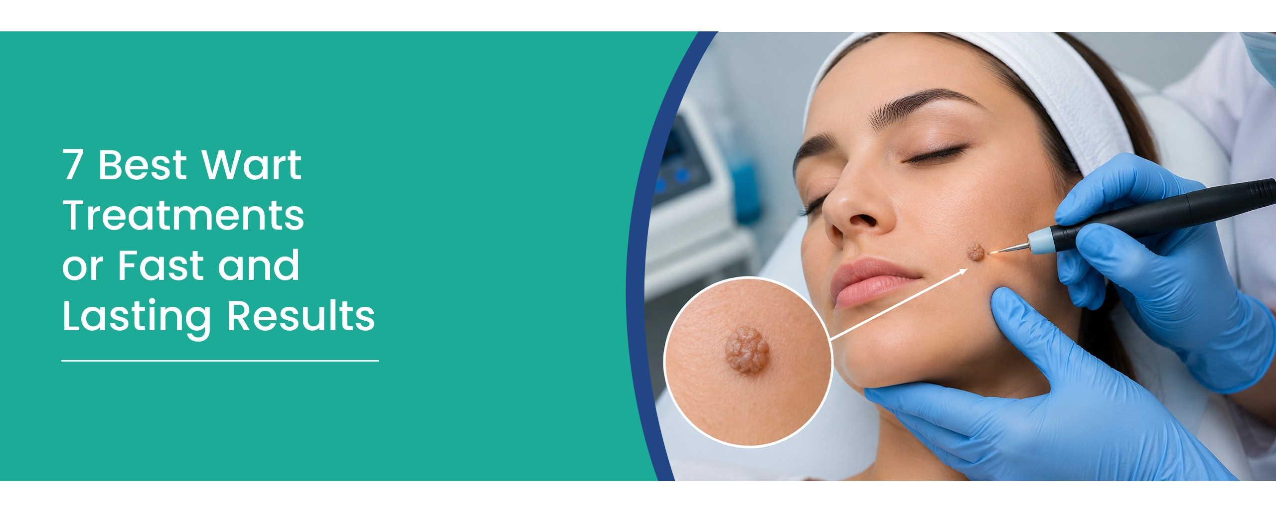 7 Best Wart Treatment