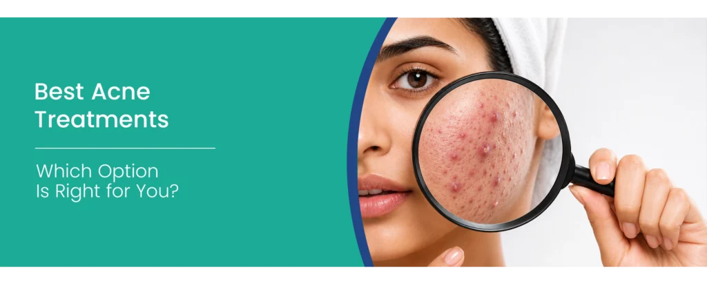 Acne Treatments