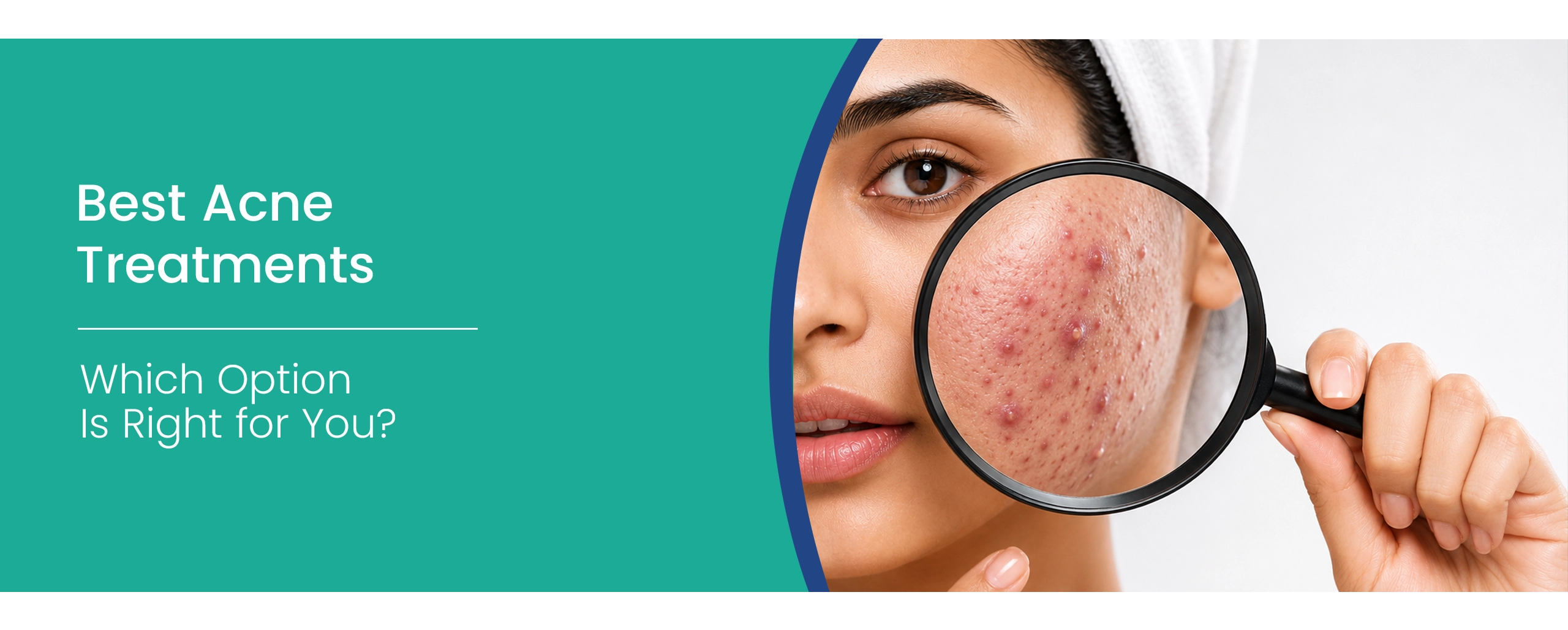 Acne Treatments