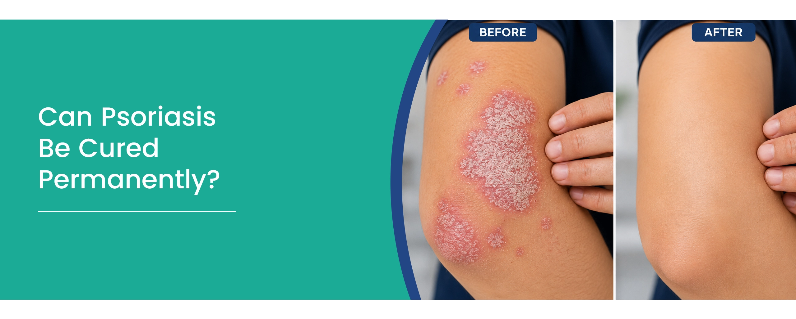 Psoriasis Treatment