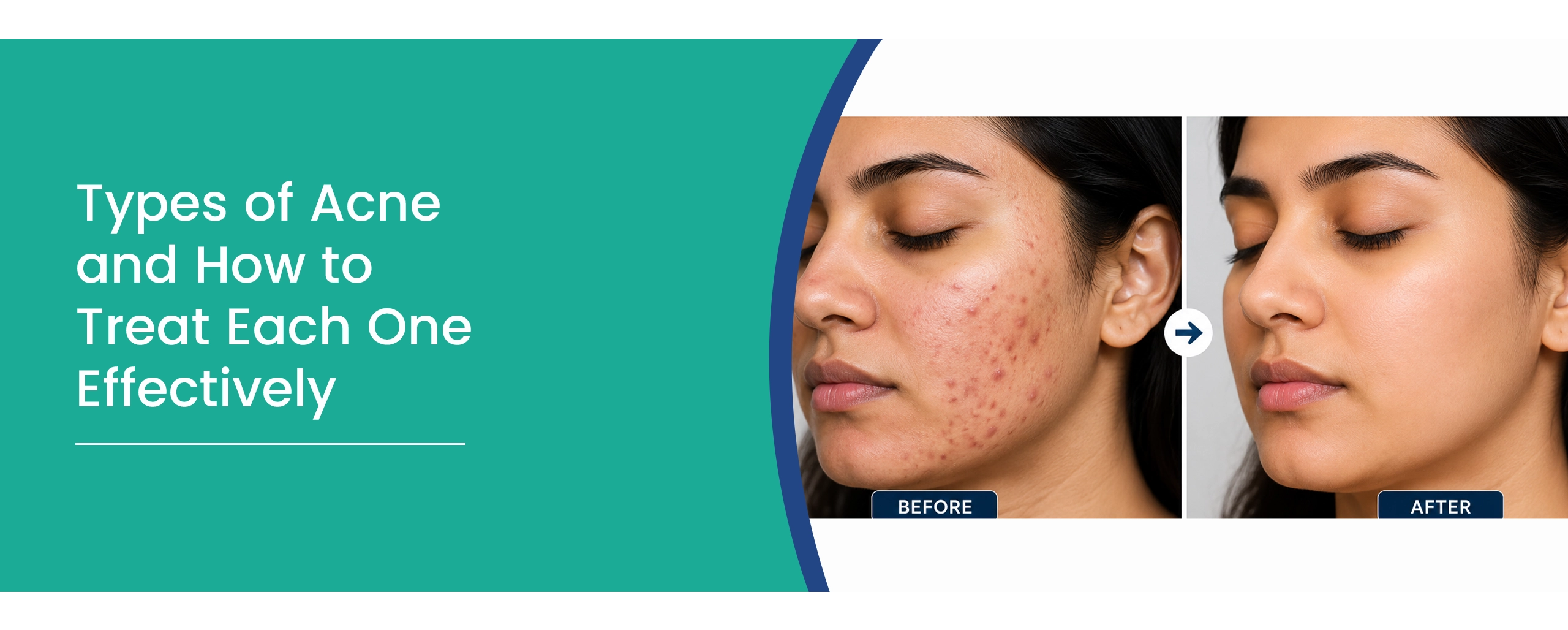 Types of Acne