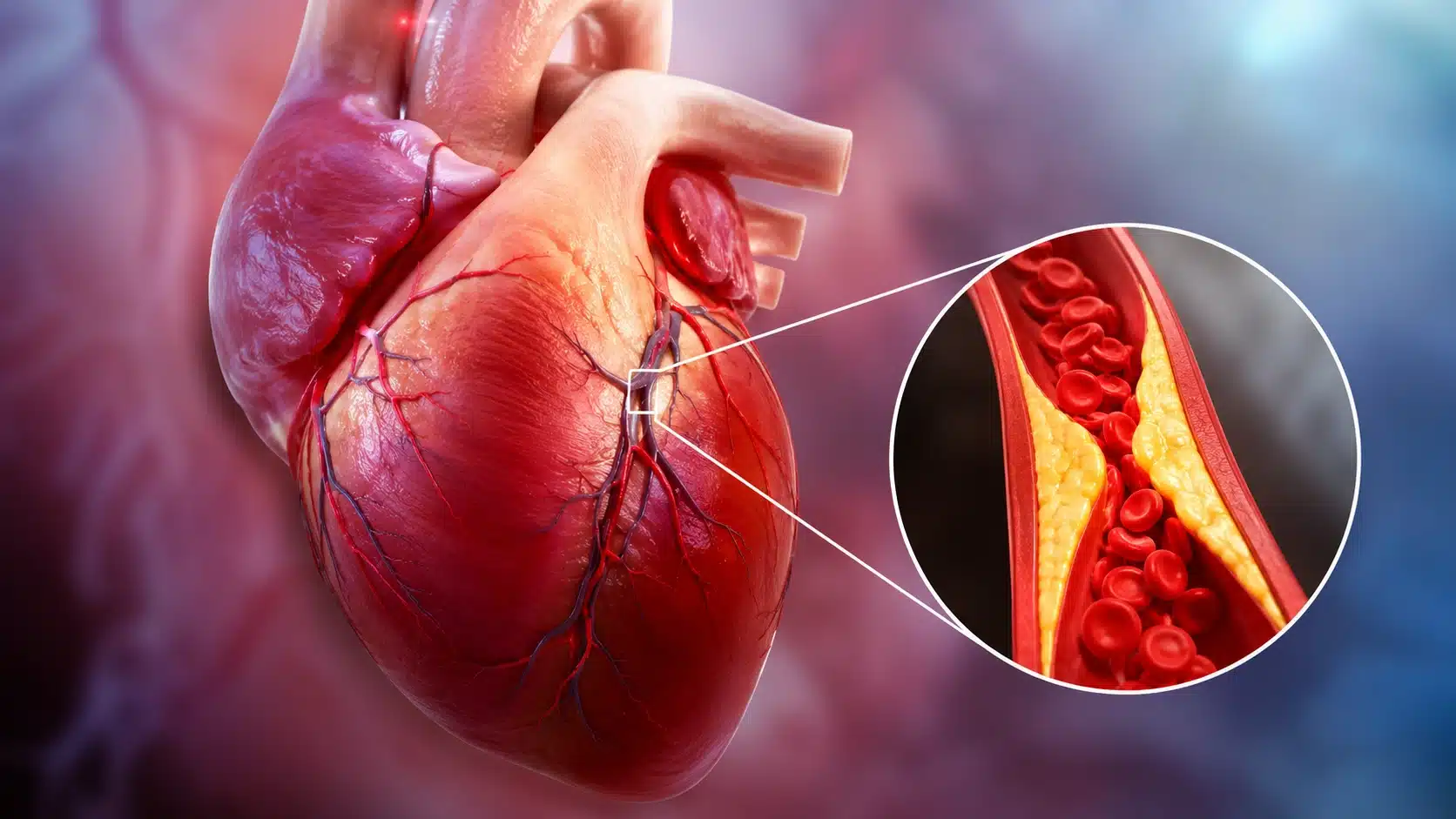 Coronary Artery Disease (CAD)