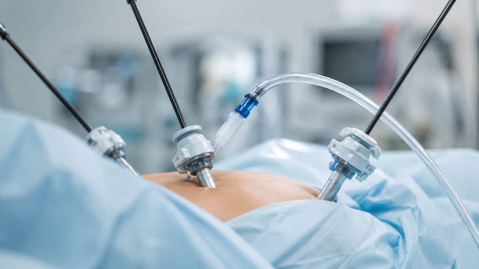 Laparoscopic Cholecystectomy