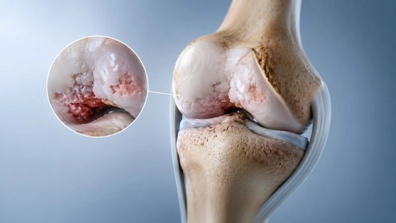 osteoarthritis