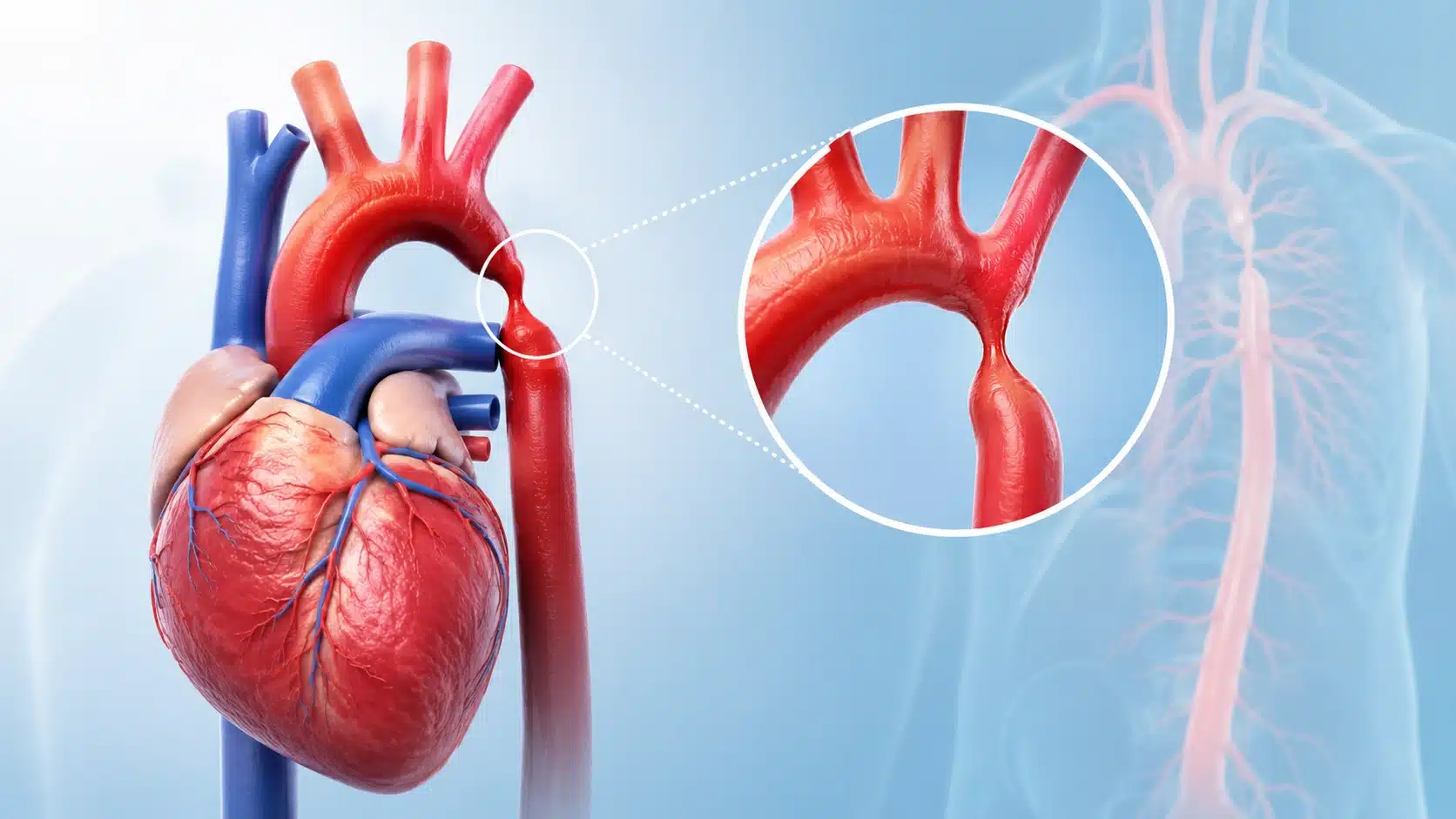 Coarctation of Aorta