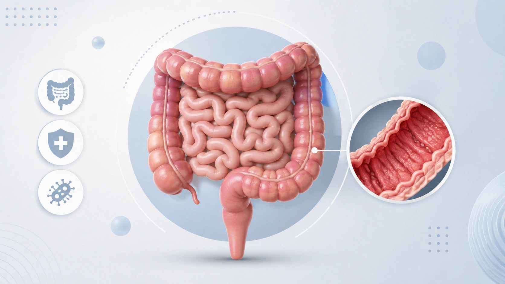 IBD