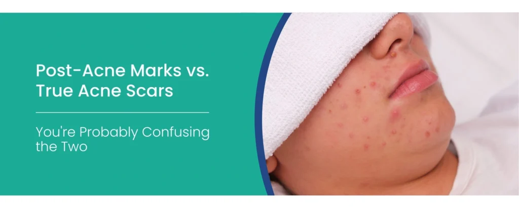 True Acne Scars
