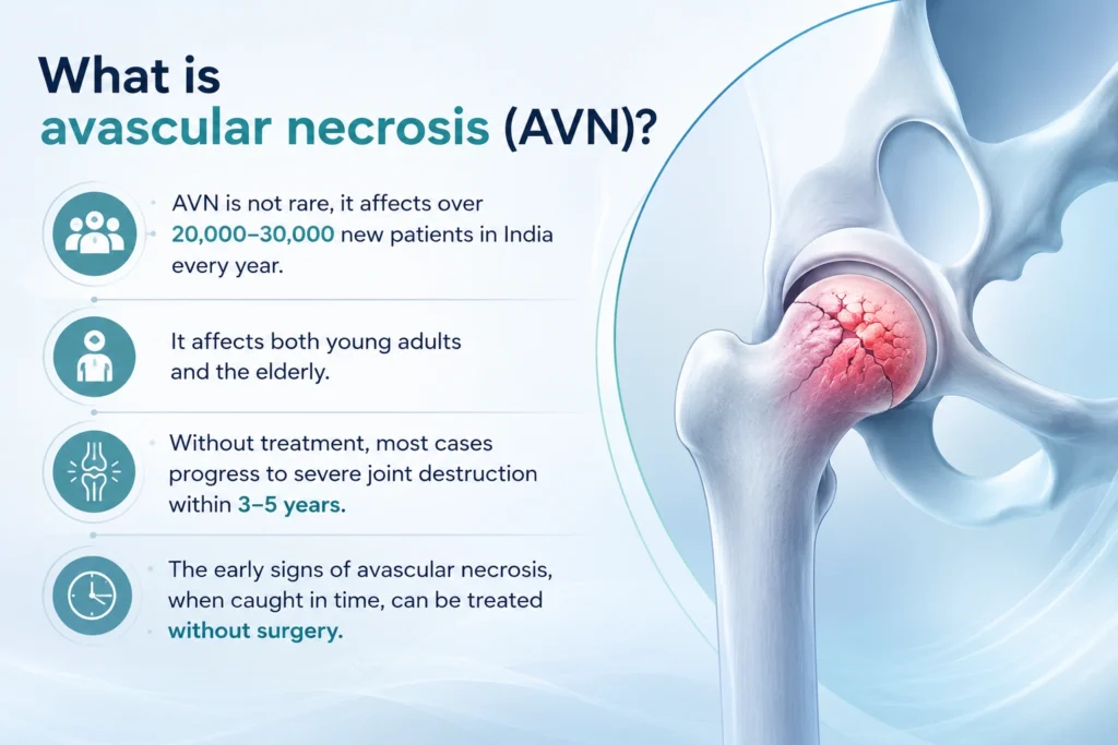 What is avascular necrosis (AVN)