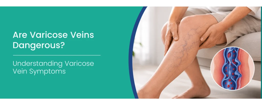 Varicose Vein Symptoms