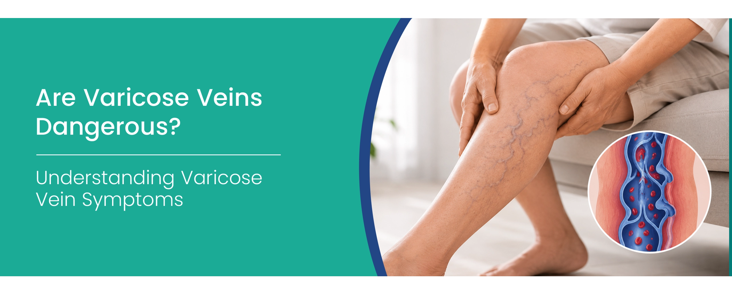 Varicose Vein Symptoms