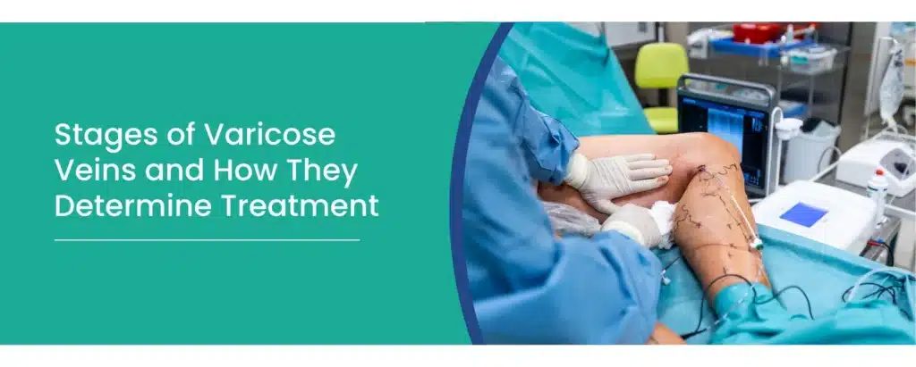 Stages of varicose veins