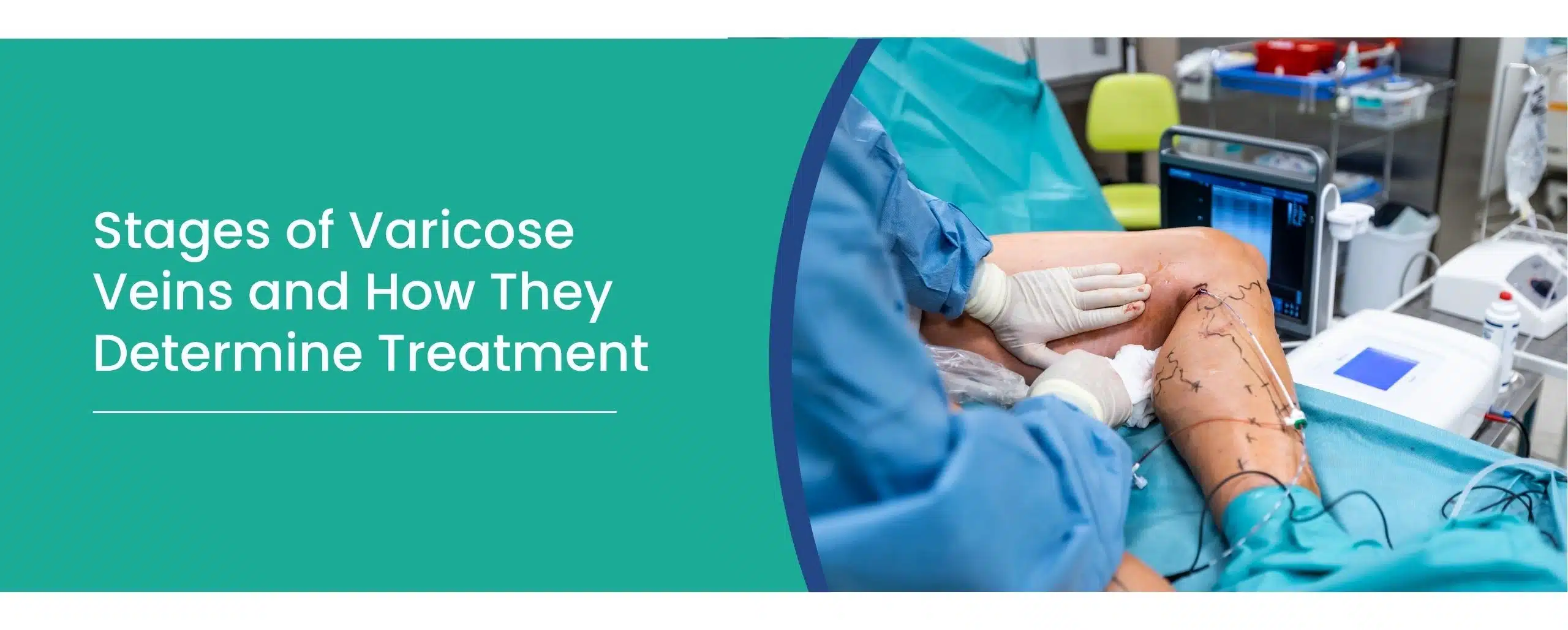 Stages of varicose veins