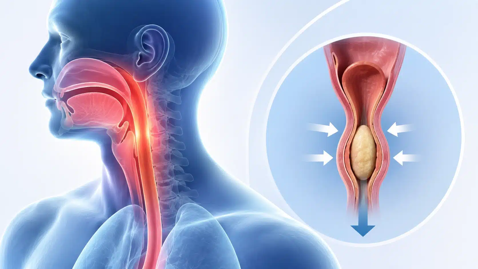 Dysphagia