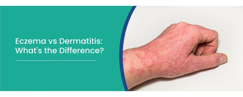 Eczema