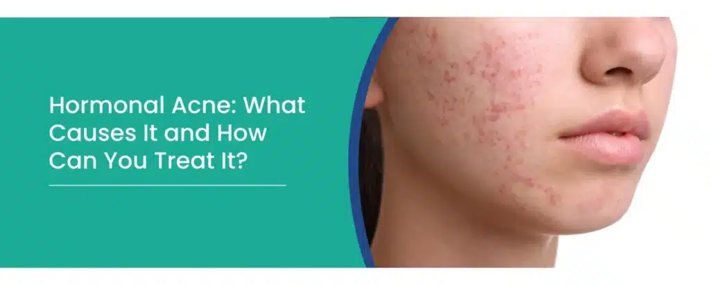 Hormonal Acne