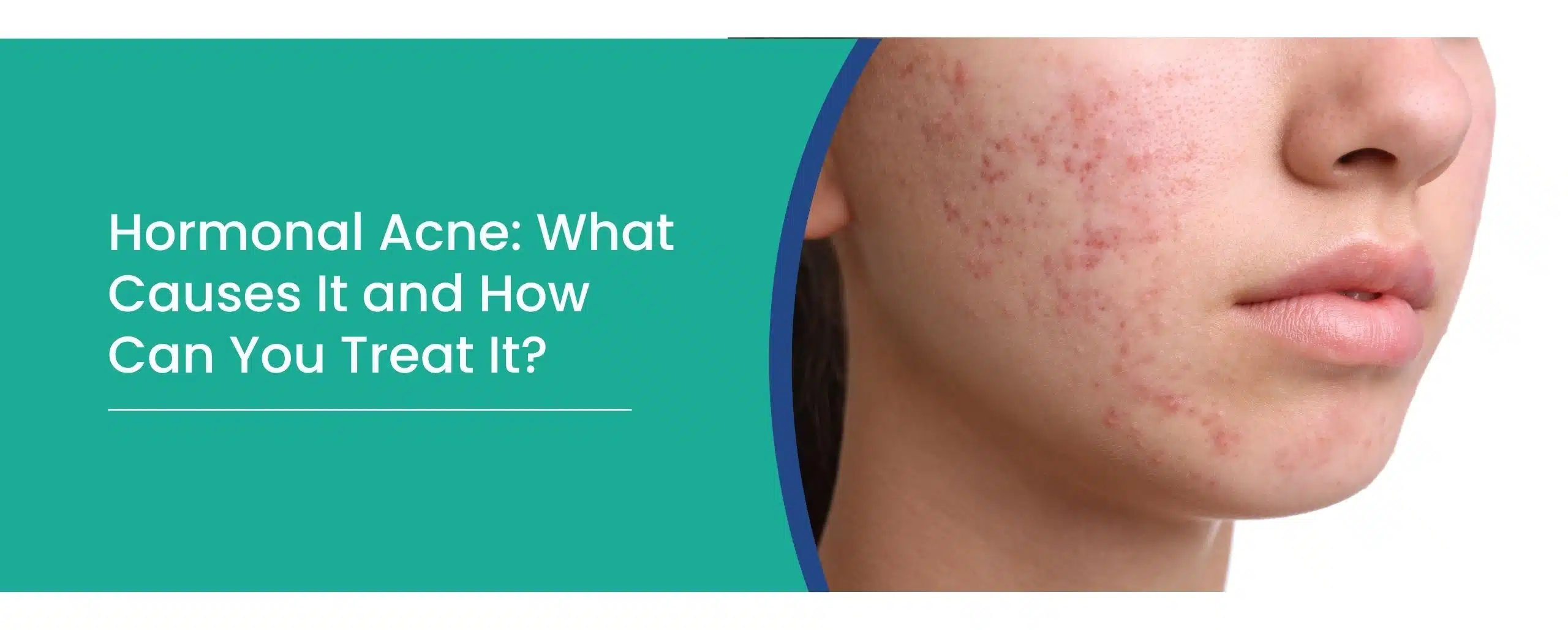 Hormonal Acne