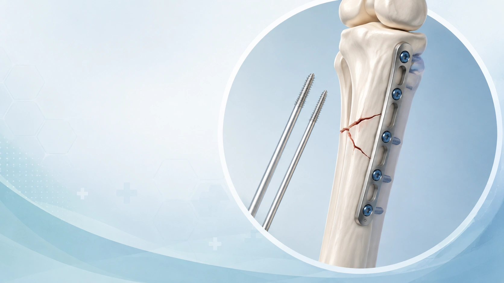 Minimally invasive fracture fixation