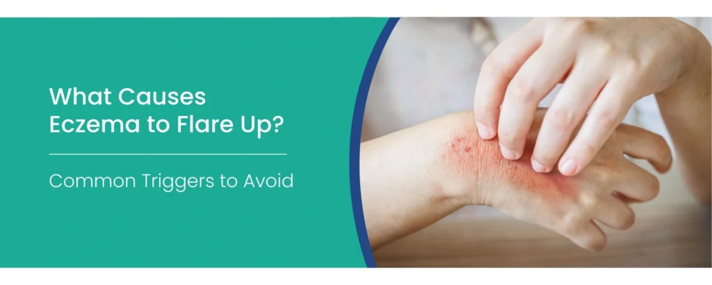 eczema flare up