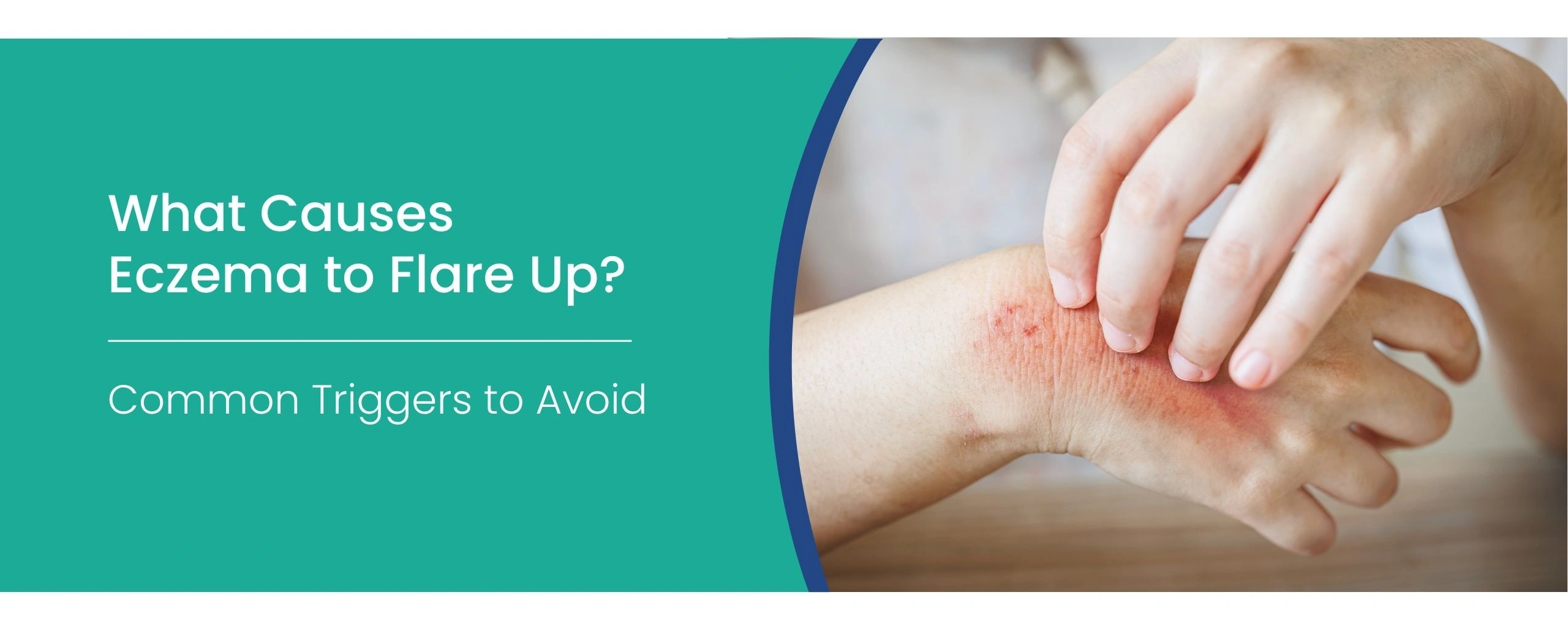 eczema flare up