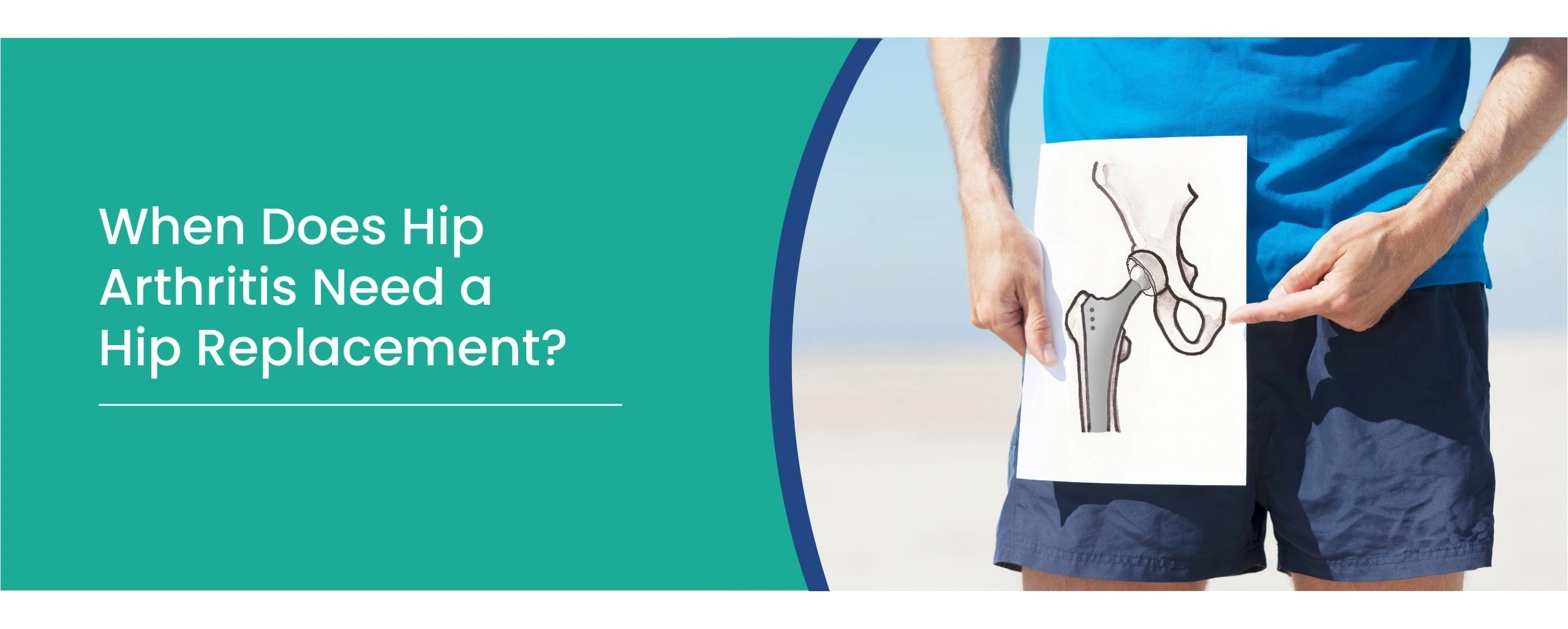 hip arthritis
