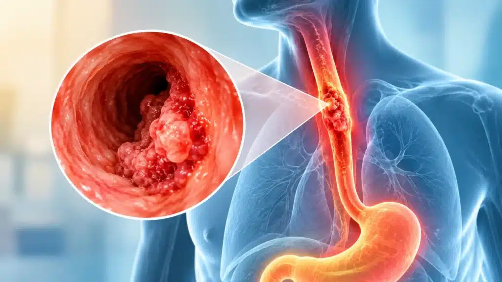 Esophageal cancer