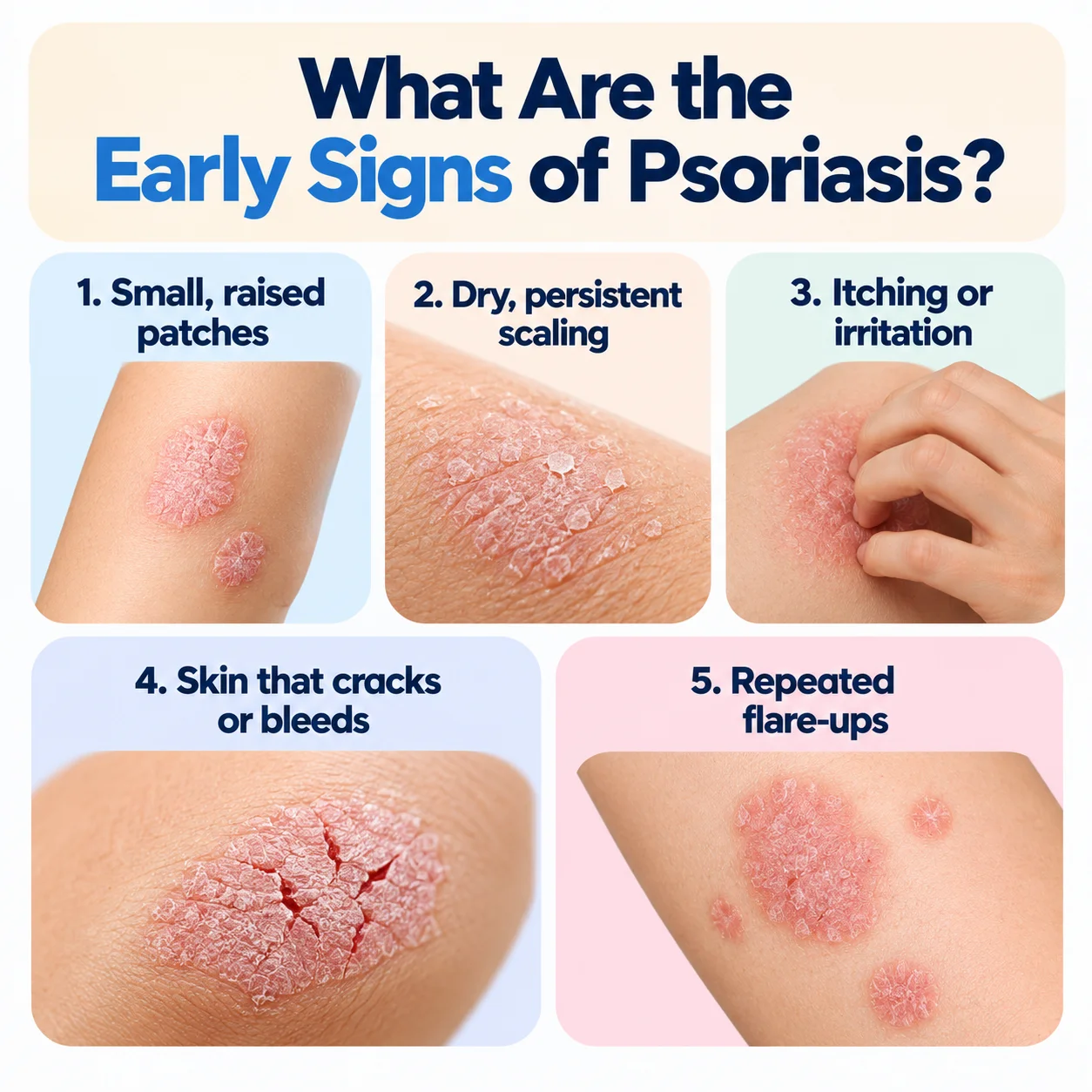 Early Signs of Psoriasis