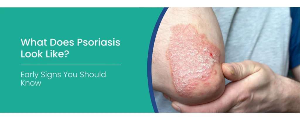 Psoriasis